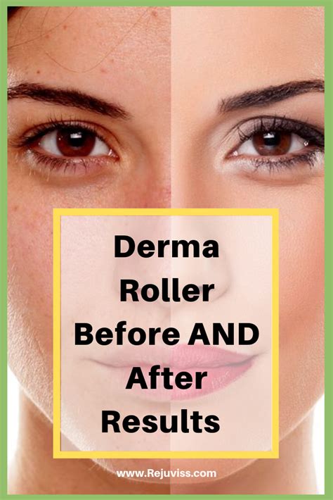 skin care before and after dermarollers